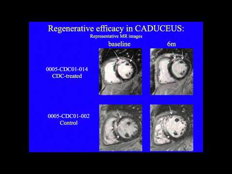 Webinar: Stem Cell Clinical Trial for Heart Disease - Lessons Learned | Eduardo Marbán