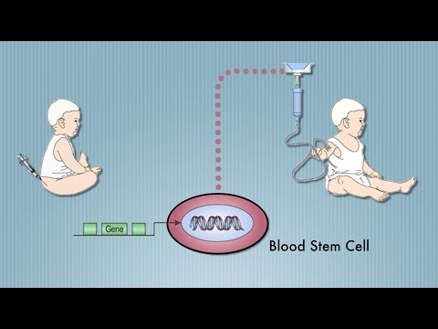 Stem Cell Cure for "Bubble Baby" Disease (SCID), Pioneered by UCLA's Don Kohn