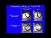 Webinar: Stem Cell Clinical Trial for Heart Disease - Lessons Learned | Eduardo Marbán