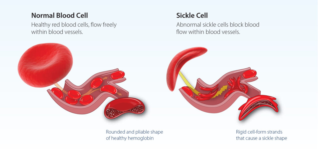 Infographic showing the difference between a normal blood cell and a Sickle Cell.